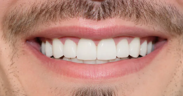 After Full Mouth Restoration Mouth After Full Mouth Restoration Mouth