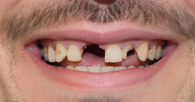 Before Full Mouth Restoration Mouth Before Full Mouth Restoration Mouth